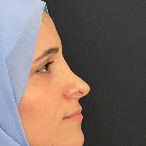 Perfiloplastia Foto antes/después